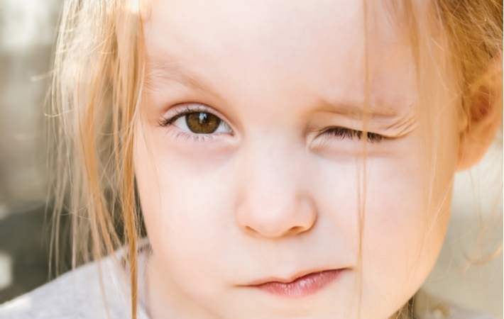 A close-up of a young girl squinting with her left eye due to the imbalance she is experiencing from lazy eye