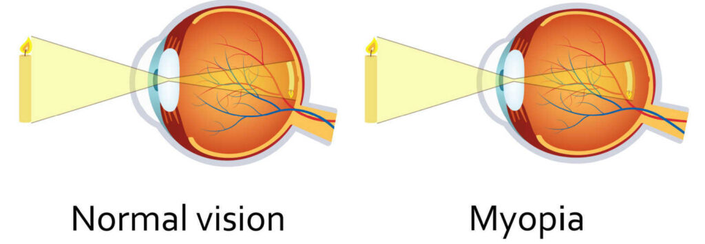 An illustration of two eyes comparing what normal vision looks versus myopia.